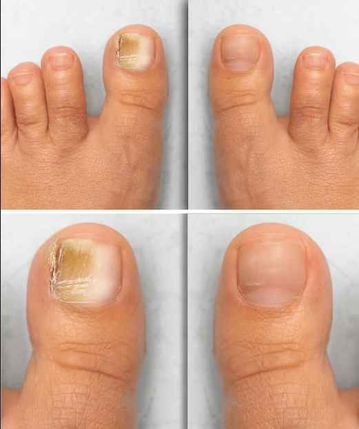 FUND FUND - Before and after treatment with fun cream