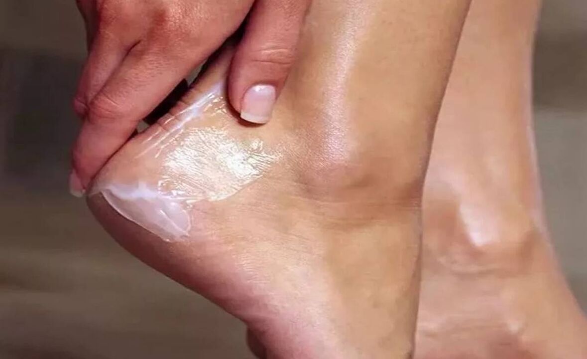 How to treat the fungus of the feet with fungus