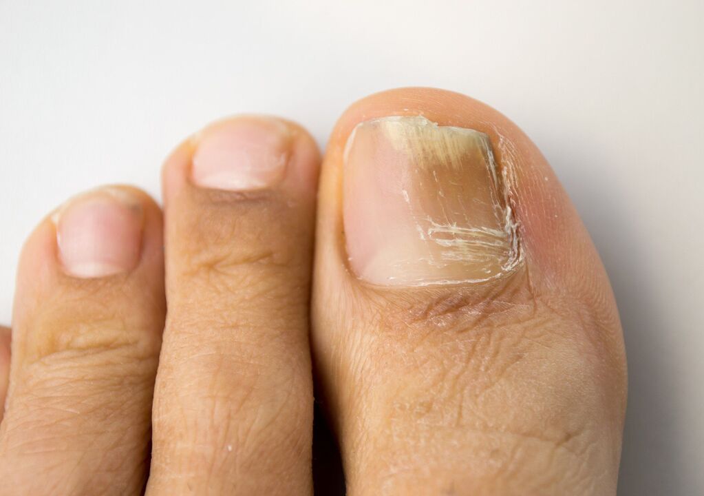 Onychomycosis