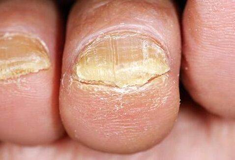 Symptoms of onychomycosis