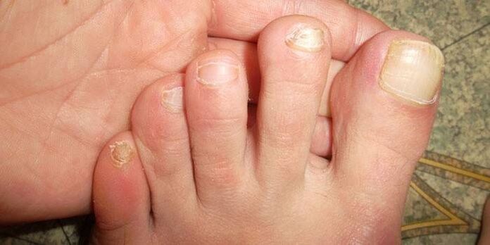Renew your nails after injury