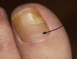 How to identify the presence of nail fungus on the thumb of the leg