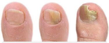 The stage of fungus development on nails
