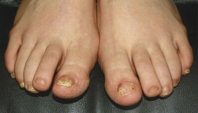 Signs and symptoms of fungi on nails