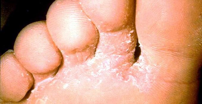 Fungal lesions in the skin between the toes