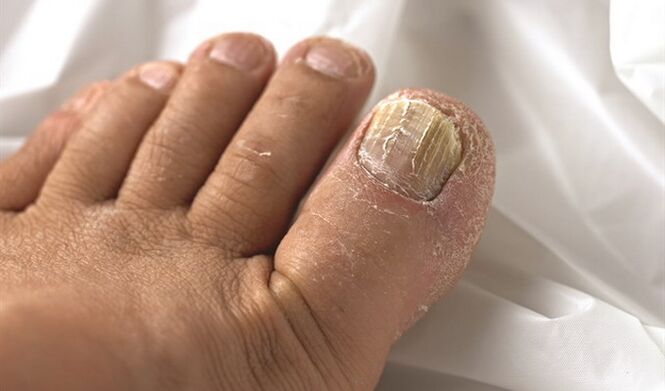 Spread fungal lesions to nail discs