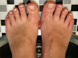 Fungus and leg skin on nails