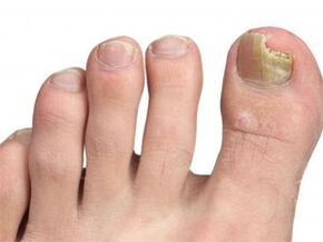 Yellow spots on nails of fungus foot pedals