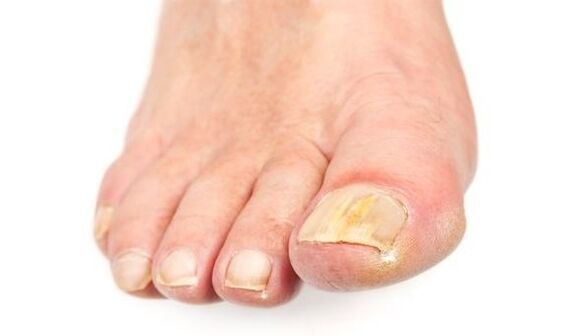 Yellowing of nails due to fungal infection