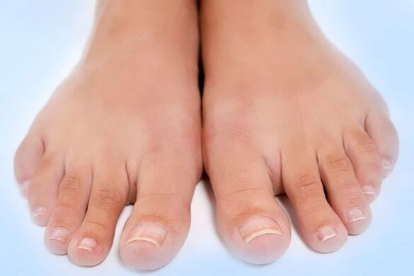Onychomycosis