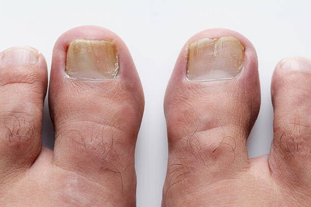 Types of toenail fungus