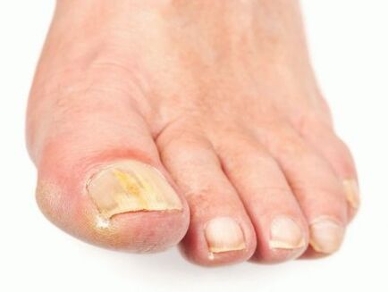 Fungal nail damage