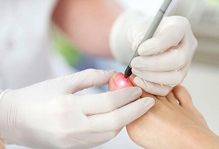 Laser treatment for toenail fungus