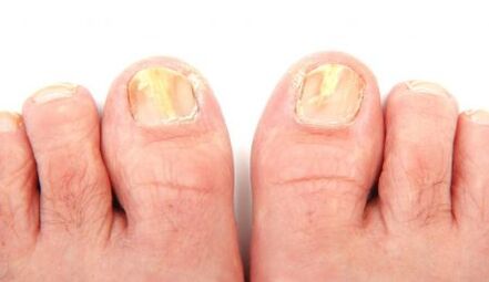 Symptoms of onychomycosis