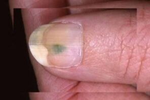 deck fungal infection