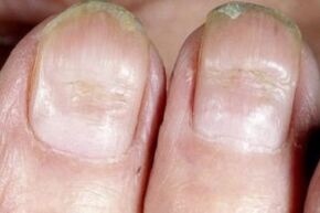 fungal symptoms on nails
