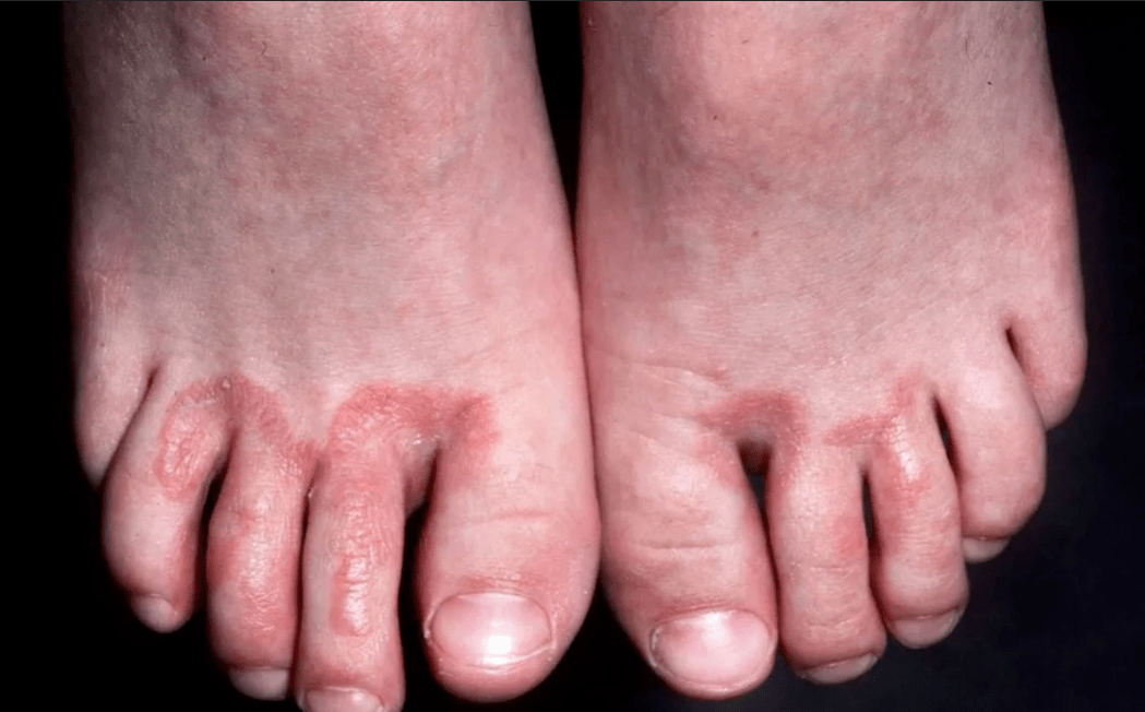 Complications of onychomycosis