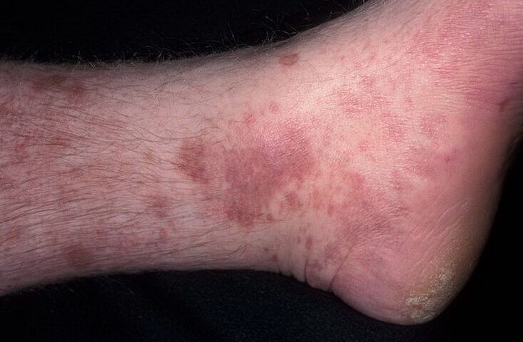 Fungal eczema on legs
