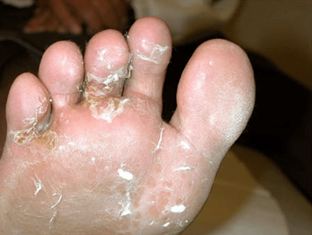 fungus on toes