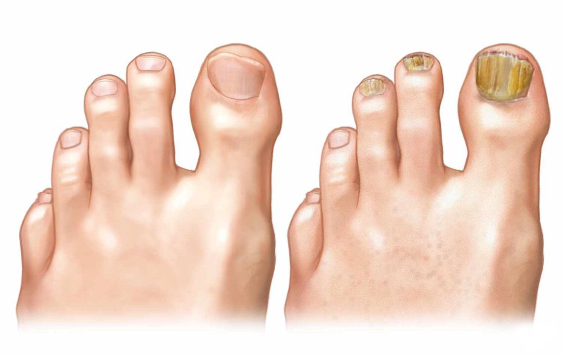 Healthy fingernail and toenail fungus