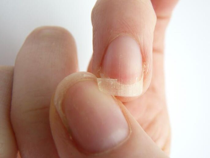 Nail loss caused by fungus