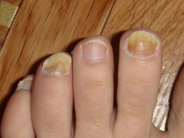 Symptoms of toenail fungus