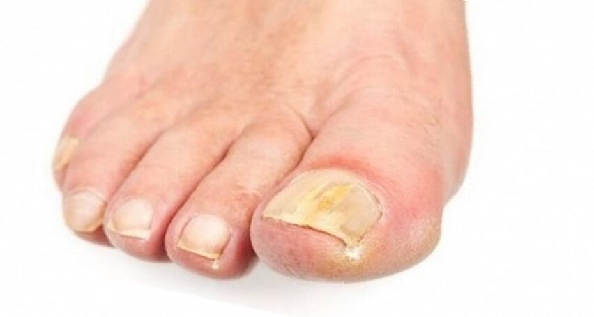 Yellowing of nails due to fungus