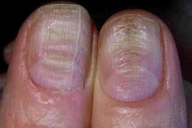 deck fungal infection