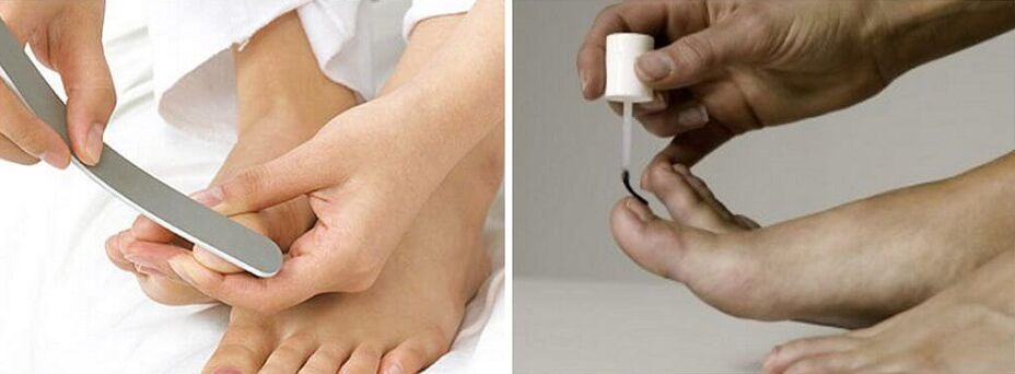 Treat toenail fungus with varnish