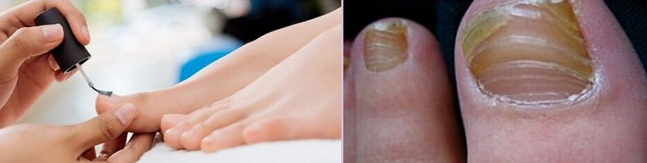 Use varnish to treat fungus