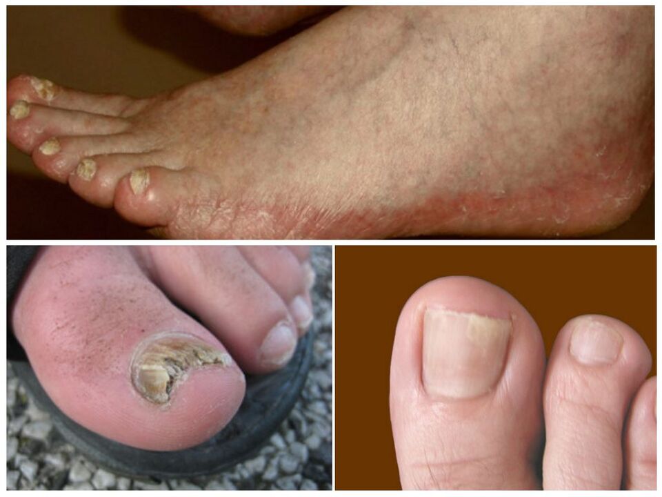 Types of foot fungus