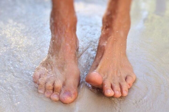 Walking barefoot is one way to contract onychomycosis